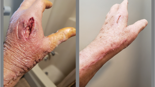 two pictures of hands demonstrating healing progress from the first to the second photo