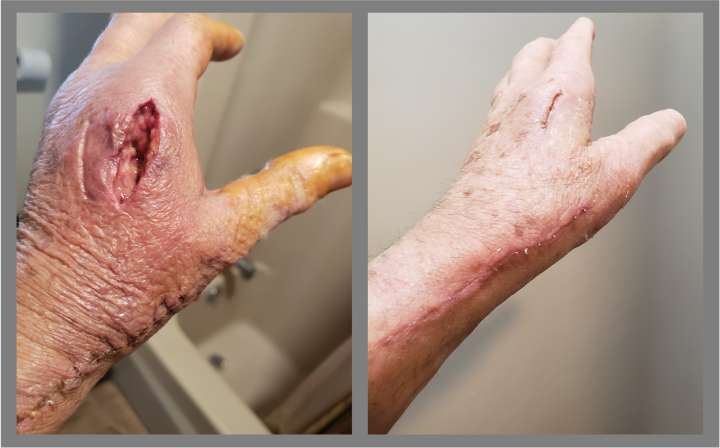 two pictures of hands demonstrating healing progress from the first to the second photo