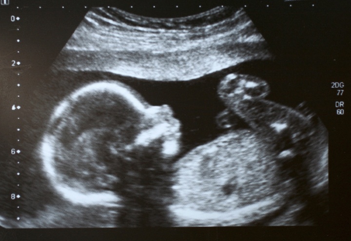 Ultrasound of baby in the womb.