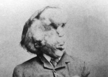 Joseph Merrick - "Elephant Man"