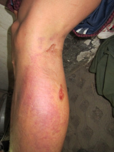 Bruised leg after the accident