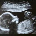 Ultrasound of baby in the womb.