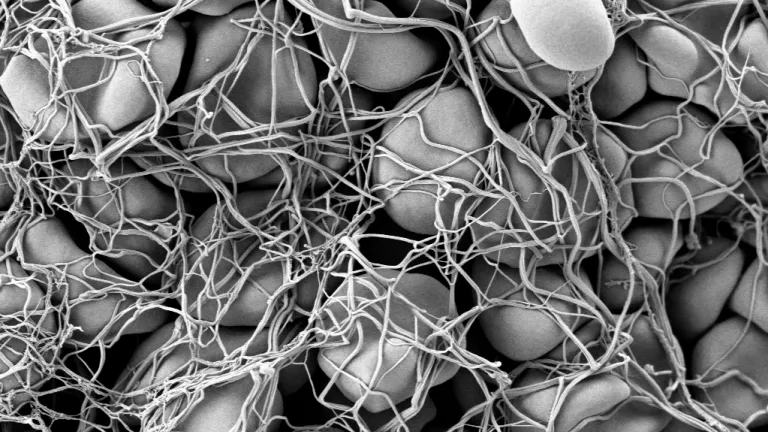 When blood clots, either everything works perfectly or the likely outcome is death. Red blood cells trapped in a fibrin network in a blood clot