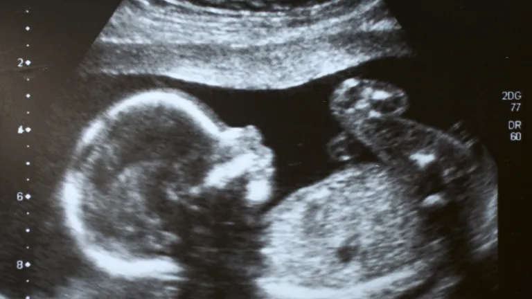 Ultrasound of baby in the womb.