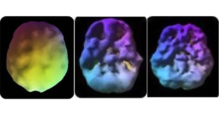 1st: The healthy pre-frontal cortex. 2nd: 18 year old­—3 year history of 4 times a week use. Underside view shows decreased pre-frontal cortex and temporal lobe activity. 3rd: 28 year old—10 year use. Underside also shows decreased activity.