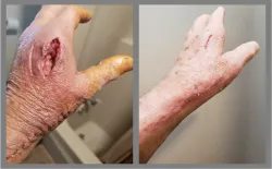 two pictures of hands demonstrating healing progress from the first to the second photo