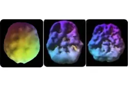 1st: The healthy pre-frontal cortex. 2nd: 18 year old­—3 year history of 4 times a week use. Underside view shows decreased pre-frontal cortex and temporal lobe activity. 3rd: 28 year old—10 year use. Underside also shows decreased activity.